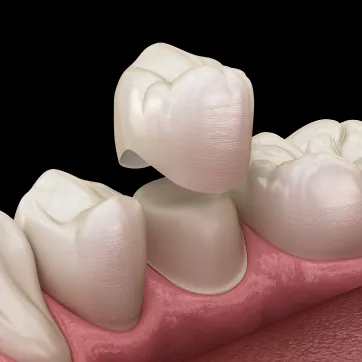 Dental Crowns at Mission Dental Group