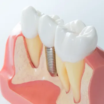 Dental Implants at Mission Dental Group