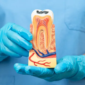 Root Canal Treatment at Mission Dental Group